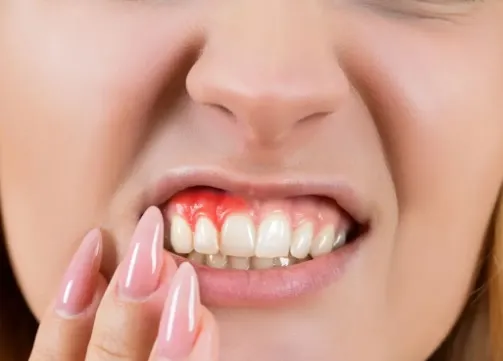 Jak leczyć nadwrażliwość zębów wynikającą z chorób dziąseł?